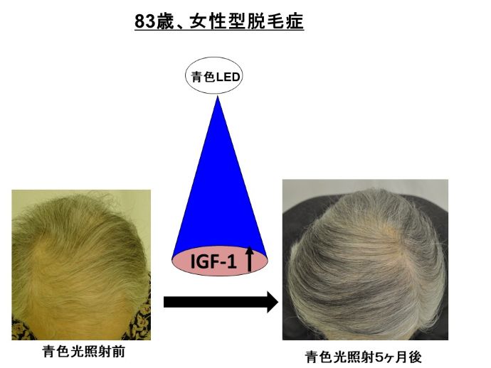 円形脱毛症　病院